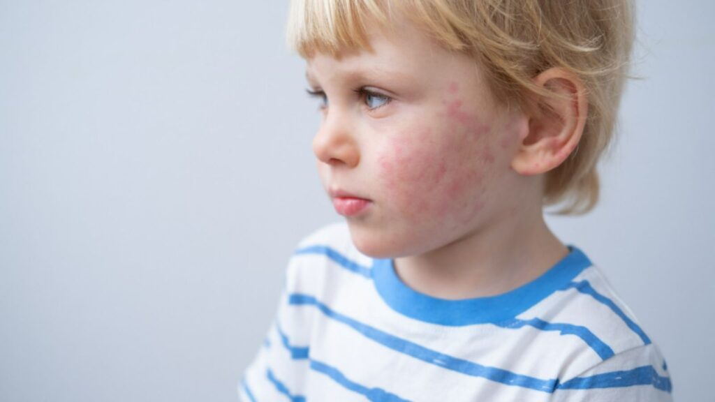 allergic reactions